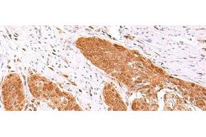 Immunohistochemistry of paraffin-embedded Human esophagus cancer tissue using FDPS Polyclonal Antibody at dilution of 1:60(x200) (FDPS anticorps)