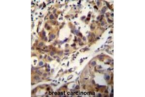 CCDC17 antibody (C-term) immunohistochemistry analysis in formalin fixed and paraffin embedded human breast carcinoma followed by peroxidase conjugation of the secondary antibody and DAB staining.