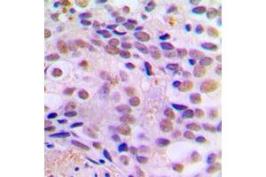 Immunohistochemical analysis of CREB (pS121) staining in human breast cancer formalin fixed paraffin embedded tissue section.