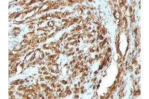 Formalin-fixed, paraffin-embedded human rhabdomyosarcoma stained with pan Muscle Actin antibody (HHF35 + MSA/953) (Pan Muscle Actin anticorps)