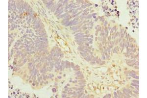 Immunohistochemistry of paraffin-embedded human ovarian cancer using ABIN7157306 at dilution of 1:100 (KLHDC5 anticorps  (AA 1-410))