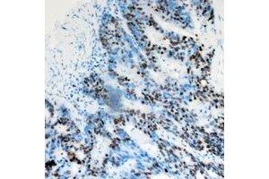 Immunohistochemical analysis of DACH1 staining in human colon cancer formalin fixed paraffin embedded tissue section. (DACH1 anticorps)