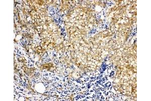 IHC-P: Vinculin antibody testing of human breast cancer tissue