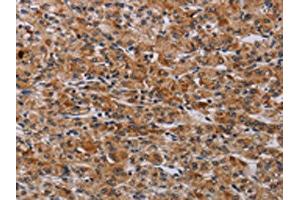 The image on the left is immunohistochemistry of paraffin-embedded Human prostate cancer tissue using ABIN7190614(F2RL2 Antibody) at dilution 1/30, on the right is treated with synthetic peptide. (F2RL2 anticorps)