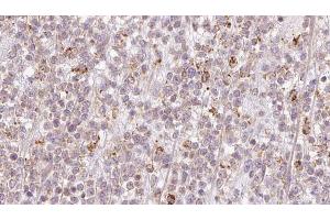 ABIN6273206 at 1/100 staining Human lymph cancer tissue by IHC-P.