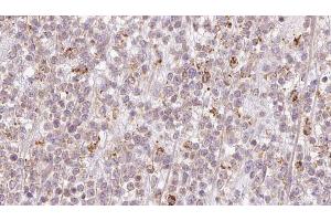 ABIN6273206 at 1/100 staining Human lymph cancer tissue by IHC-P. (CCDC93 anticorps  (C-Term))