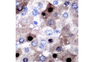 Immunohistochemical analysis of SULT2B1 staining in human liver cancer formalin fixed paraffin embedded tissue section. (SULT2B1 anticorps)