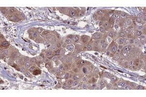 ABIN6269009 at 1/100 staining Human liver cancer tissue by IHC-P. (SLC2A3 anticorps  (C-Term))