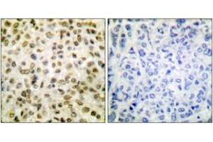 Immunohistochemistry analysis of paraffin-embedded human breast carcinoma tissue, using Histone H1 (Acetyl-Lys25) Antibody. (Histone H1 anticorps  (acLys25))
