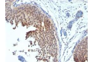 Immunohistochemical staining (Formalin-fixed paraffin-embedded sections) of human bladder carcinoma with KRT6 monoclonal antibody, clone SPM269 .