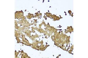 Immunohistochemistry of paraffin-embedded human mammary cancer using CTNNB1 antibody.