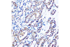 Immunohistochemistry of paraffin-embedded Human thyroid cancer using STK26 Rabbit pAb (ABIN7270231) at dilution of 1:100 (40x lens).