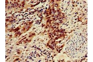 Immunohistochemistry of paraffin-embedded human bladder cancer using ABIN7176497 at dilution of 1:100 (ZNF695 anticorps  (AA 1-88))