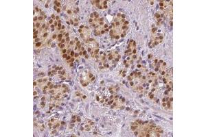 IHC analysis of paraffin-embedded human prostate cancer tissue, using SPOP antibody (1/200 dilution). (SPOP-B anticorps)