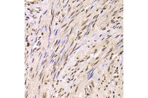 Immunohistochemistry of paraffin-embedded Human adenomyosis using SNRPA antibody at dilution of 1:100 (x400 lens). (SNRPA1 anticorps)