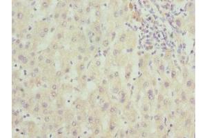 Immunohistochemistry of paraffin-embedded human liver cancer using ABIN7166597 at dilution of 1:100 (Small EDRK-Rich Factor 1A (SERF1A) (AA 140-240) anticorps)