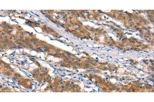 Immunohistochemistry of paraffin-embedded Human gastric cancer tissue using CUL4B Polyclonal Antibody at dilution 1:50