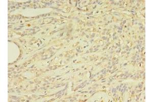 Immunohistochemistry of paraffin-embedded human breast cancer using ABIN7144889 at dilution of 1:100 (ABCB5 anticorps  (AA 547-760))