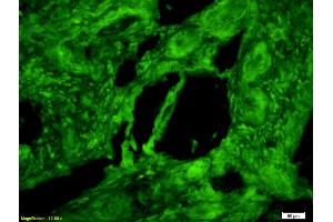 Formalin-fixed and paraffin-embedded human rectal carcinoma with Anti-M2-PK/PKM2 Polyclonal Antibody, Unconjugated 1:200, overnight at 4°C, The secondary antibody was Goat Anti-Rabbit IgG, Cy3 conjugated used at 1:200 dilution for 40 minutes at 37°C.
