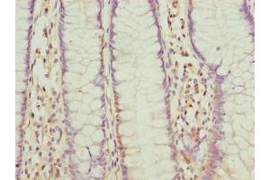 Immunohistochemistry of paraffin-embedded human colon cancer using ABIN7152521 at dilution of 1:100 (FAD Synthetase anticorps  (AA 1-490))