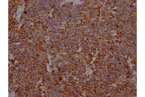 IHC image of ABIN7127670 diluted at 1:100 and staining in paraffin-embedded human lung cancer performed on a Leica BondTM system. (Recombinant PD-L1 anticorps)
