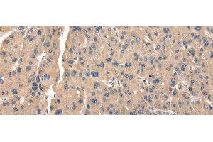 Immunohistochemistry of paraffin-embedded Human thyroid cancer tissue using ZFAND5 Polyclonal Antibody at dilution of 1:35(x200)