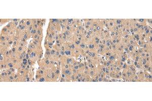 Immunohistochemistry of paraffin-embedded Human thyroid cancer tissue using ZFAND5 Polyclonal Antibody at dilution of 1:35(x200) (ZFAND5 anticorps)