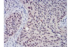 Immunohistochemical analysis of paraffin-embedded cervical cancer tissues using CBX4 mouse mAb with DAB staining.