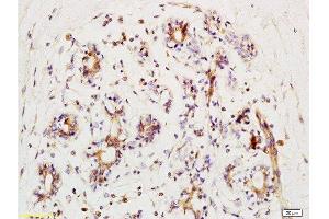 Formalin-fixed and human kidney carcinoma tissue labeled with Anti-phospho-BACH1/BRIP1(Ser990) Polyclonal Antibody, Unconjugated  at 1:200 followed by conjugation to the secondary antibody and DAB staining