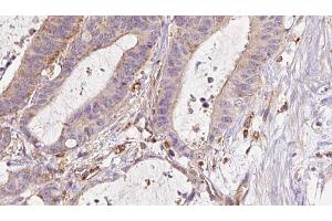 ABIN6273044 at 1/100 staining Human liver cancer tissue by IHC-P. (ETFB anticorps  (Internal Region))