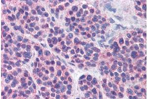 Anti-MBOAT4 antibody  ABIN960793 IHC staining of human thyroid, medullary carcinoma. (MBOAT4 anticorps  (Internal Region))
