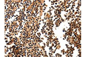 The image on the left is immunohistochemistry of paraffin-embedded Human tonsil tissue using ABIN7190676(FOXB2 Antibody) at dilution 1/5, on the right is treated with synthetic peptide. (FOXB2 anticorps)