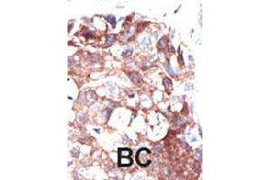 Formalin-fixed and paraffin-embedded human cancer tissue reacted with UBQLN1 polyclonal antibody  , which was peroxidase-conjugated to the secondary antibody, followed by DAB staining. (Ubiquilin 1 anticorps  (N-Term))