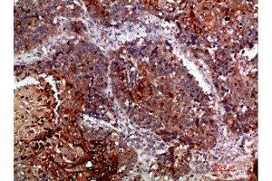 Immunohistochemical analysis of paraffin-embedded human-lung-cancer, antibody was diluted at 1:200 (MLL/KMT2A anticorps  (AA 3850-3900))