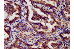 IHC image of ABIN7167803 diluted at 1:300 and staining in paraffin-embedded human lung cancer performed on a Leica BondTM system.