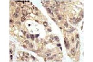 IHC analysis of FFPE human breast carcinoma tissue stained with the SUMO1 antibodyFITC-conjugated goat-anti-rabbit secondary Ab was used for the analysis.