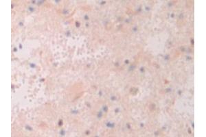 Detection of ATF4 in Human Glioma Tissue using Polyclonal Antibody to Activating Transcription Factor 4 (ATF4)