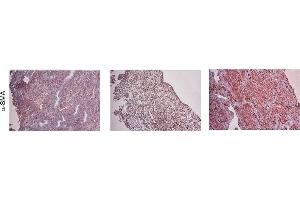 IHC of the expression patterns of (myo)fibroblast, TGFβ1, CTGF, and collagen in human adenomyotic endometrium specimens.
