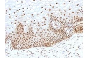 Formalin-fixed, paraffin-embedded human cervical carcinoma stained with TOX3 antibody (TOX3/1123).