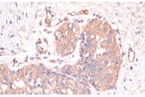 Immunohistochemistry of paraffin-embedded Human mammary cancer using Caspase-3 Polyclonal Antibody at dilution of 1:200 (40x lens). (Caspase 3 anticorps)