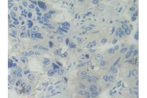 Detection of BCAM in Human Breast cancer Tissue using Polyclonal Antibody to Basal Cell Adhesion Molecule (BCAM)