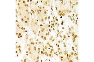 Immunohistochemistry of paraffin-embedded Human gastric using DKC1 antibody at dilution of 1:100 (x400 lens). (DKC1 anticorps  (AA 245-514))