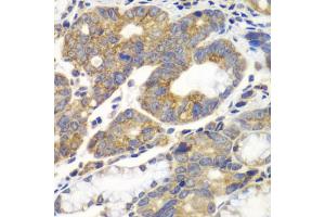 Immunohistochemistry of paraffin-embedded human gastric cancer using PFKM antibody. (PFKM anticorps)