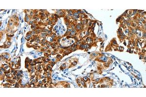 Immunohistochemistry of paraffin-embedded Human lung cancer using ALDH6A1 Polyclonal Antibody at dilution of 1:45 (ALDH6A1 anticorps)