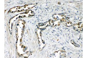 Anti-CXCR1 antibody, IHC(P) IHC(P): Human Lung Cancer Tissue (CXCR1 anticorps  (N-Term))