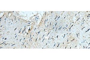 Immunohistochemistry of paraffin-embedded Human gastric cancer tissue using RAPSN Polyclonal Antibody at dilution of 1:40(x200)