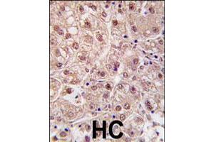 Formalin-fixed and paraffin-embedded human hepatocellular carcinoma reacted with PSMA5 polyclonal antibody  , which was peroxidase-conjugated to the secondary antibody, followed by DAB staining. (PSMA5 anticorps  (N-Term))