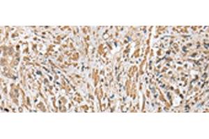 Immunohistochemistry of paraffin-embedded Human prost ate cancer tissue using CNPY2 Polyclonal Antibody at dilution of 1:25(x200) (CNPY2/MSAP anticorps)