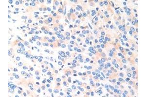 Detection of CTSK in Human Prostate cancer Tissue using Polyclonal Antibody to Cathepsin K (CTSK)