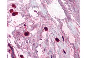 Anti-TPSAB1 / Mast Cell Tryptase antibody IHC of human breast, mast cells. (TPSAB1 anticorps)